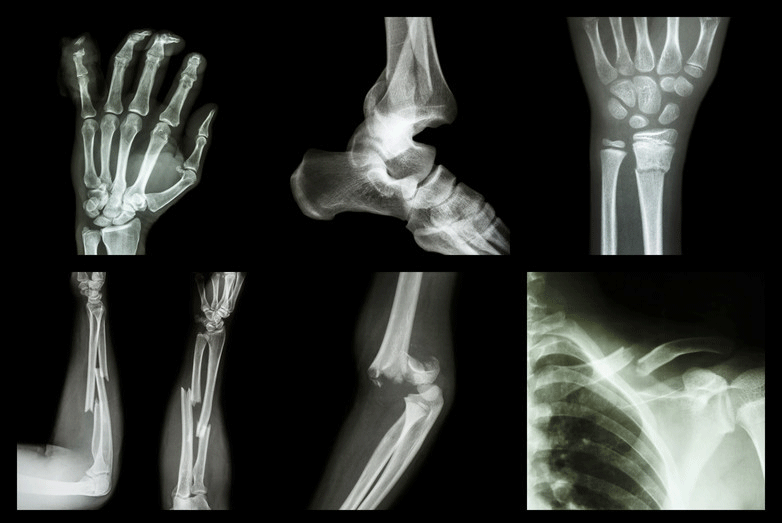 6 Ways To Help Heal Broken Bones Faster