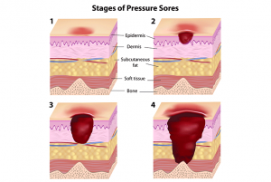 How-To-Help-Wheelchair-Patients-Prevent-Pressure-Ulcers - Stellar ...