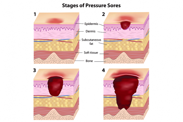 How To Help Wheelchair Patients Prevent Pressure Ulcers