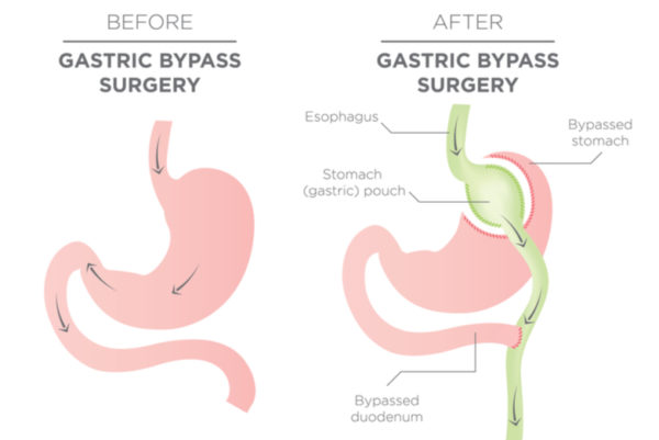 Muscle Pain After Bariatric Surgery